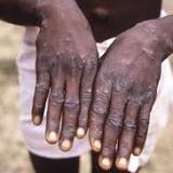 Peer-Reviewed Study Finds Monkeypox Primarily Transmitted Sexually by Men