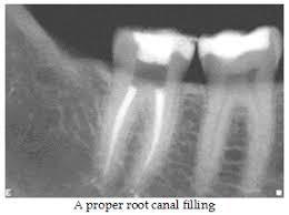 root canal fillings